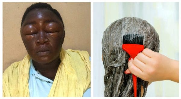 See What A Nigerian Woman Revealed That Hair Dye Did To Her (Photos)
