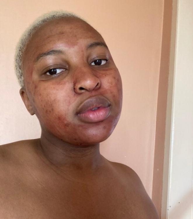 Lady who applied period blood on her face for ‘clear skin’ shares her experience
